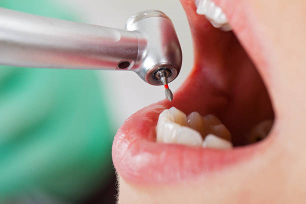 Best Emergency Tooth Extraction in Weweantic, MA